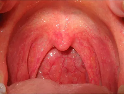 Белые полоски на горле: причины, симптомы и лечение