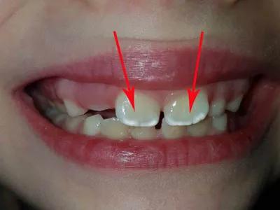 Почему на зубах белые пятна? - Стоматология Сити Дент
