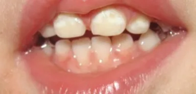 Белые Пятна На 32 Зубах У Ребенка Взрослого ЛюмиДент