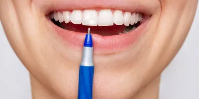 Меловидные Пятна На Зубах 9 Причин Как Лечить ЛюмиДент