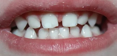 Белые пятна на зубах - причины и лечение у детей и взрослых