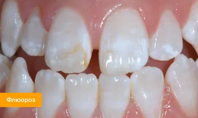 Белые пятна на молочных зубах › Денікон стоматологічні та витратні товари