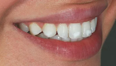 Разбираемся какие пятна на зубах бывают и как поддерживать ровный цвет зубов
