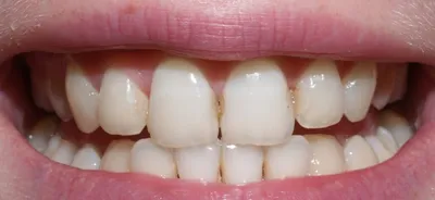 Белые пятна (точки) на зубах у ребенка - причины, симптомы, диагностика,  лечение, профилактика