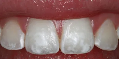 katerina_higienistka - ⁉️БЕЛЫЕ ПЯТНА Почему после отбеливания иногда  появляются белые пятна на зубах? Давайте разбираться. Важно знать: причины  появления пятен - индивидуальная особенность. У каждого существует свой  оттенок зубной эмали. Появление белых