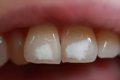 Почему на зубах появляются белые пятна. Статьи «ДОКТОР ДЕНТ».