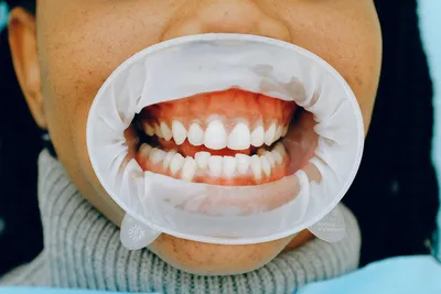 Налет на зубах - причины, виды, как убрать зубной налет