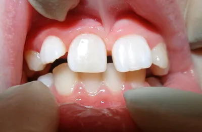Стоматология Витадент Рязань - Белые пятна на зубах Внезапно появившиеся  точки на зубной эмали белого цвета могут говорить о наличии заболевания в  организме человека. Самой распространенной причиной такого состояния  является прогрессирующий кариес,