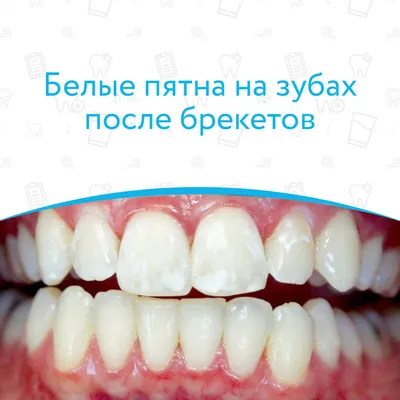 Белые пятна на передних зубах - Форум для стоматологов, зубных техников и  пациентов.