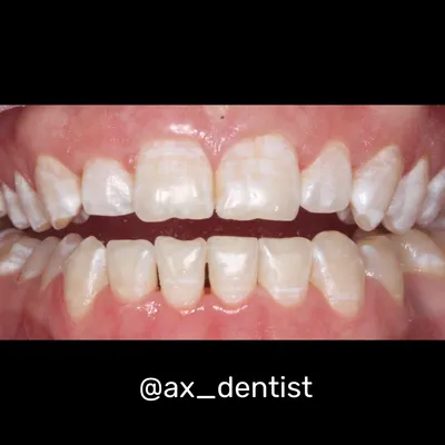 Белые пятна на зубах после брекетов - клиника Улыбка столицы