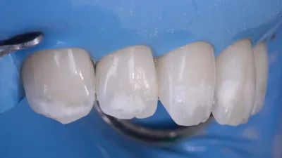 Белые пятна на зубах | возможные причины появления у взрослых - лечение и  профилактика