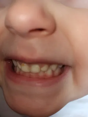 Белые пятна на зубах: лечение белых пятен у детей и взрослых в Москве —  цены на лечение меловидных пятен