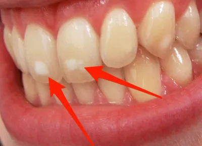 Белые пятна на зубах. Откуда берутся, что означают и как вылечить?