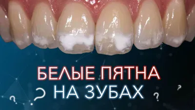 Жёлтые пятна на зубах и белые | Детская и семейная стоматологическая  клиника \"Белая Медведица\" | Санкт-Петербург