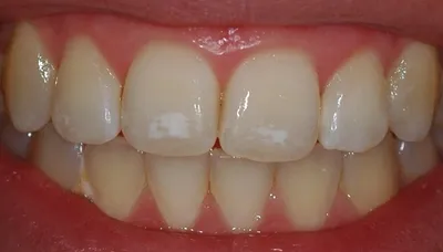 На зубах появились белые пятна: причины возникновения, способы лечения, фото