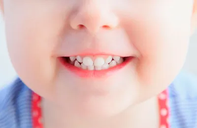 Флюороз зубов: симптомы, диагностика, лечение | Стоматология Atlantis Dental