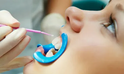 Andreeva Dental Clinic - Вас беспокоят белые пятна на зубах? ⠀ Это явление  называют гипоплазией эмали. Такие зубы больше подвержены риску развития  кариеса, нежели здоровые зубы. ⠀ На фото мы убрали пигментацию