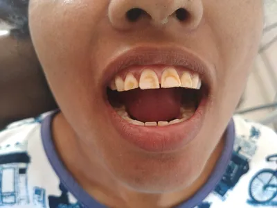 Пигментация зубов (дисколорит) - причины, что делать, как убрать, лечение