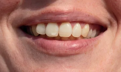 Почему на зубах белые пятна? - Стоматология Сити Дент