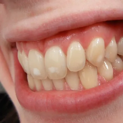 Белые Пятна На 32 Зубах У Ребенка Взрослого ЛюмиДент