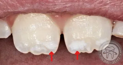 Белые пятна на зубах [как убрать, лечение, почему появились]