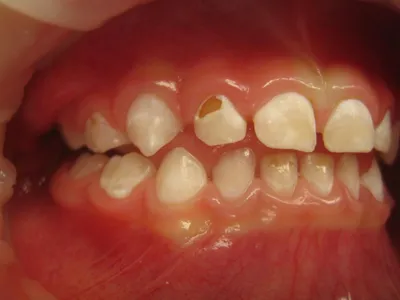 У меня появились пятна на зубах – причины образования белых пятен на зубах  | О здоровье: с медицинского на русский | Дзен