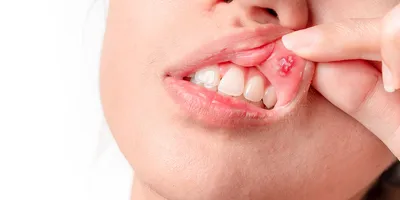 Стоматология Витадент Рязань - Белые пятна на зубах Внезапно появившиеся  точки на зубной эмали белого цвета могут говорить о наличии заболевания в  организме человека. Самой распространенной причиной такого состояния  является прогрессирующий кариес,