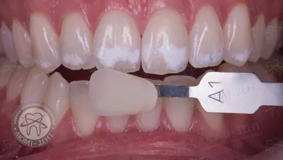 Белые пятна на зубах — причины появления, как убрать белые точки на зубах