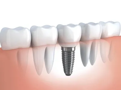 Белые пятна на эмали зубов: причины, методы лечения | | Статьи | ДентИдеал