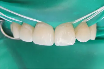 Пятна на зубах - причины, симптомы, цены на лечение в стоматологии Celt