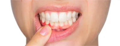 Белые пятна и меловые точки на зубах – что это значит и от чего появляется  – причины: что делать, если у взрослого на постоянных передних резцах  прозрачные полоски