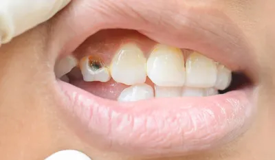 Как убрать белые пятна на зубах • Диагностический центр Вальдорф