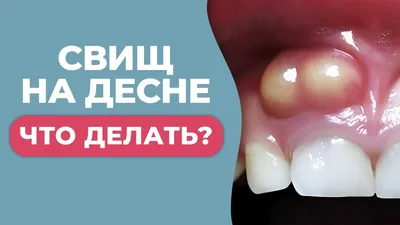 Белые пятна (точки) на зубах у ребенка - причины, симптомы, диагностика,  лечение, профилактика