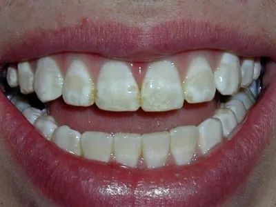 На зубах черные точки и пятна: распространенное явление и пути решения  проблемы
