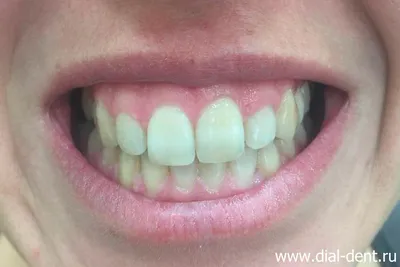 Почему появляются белые пятна на зубах? | Портал о зубах Симпладент | Дзен