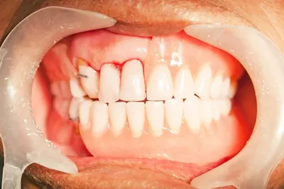 Черные точки (пятна) на зубах - почему появляются, как убрать