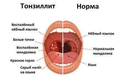 Ангина, тонзиллит, фарингит. Есть ли разница? | Алло, доктор! | Дзен