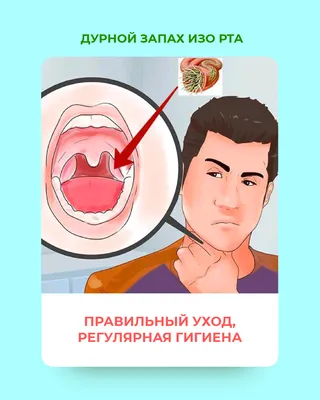 Белые комочки в горле и неприятный запах изо рта. | MVK Beauty Line