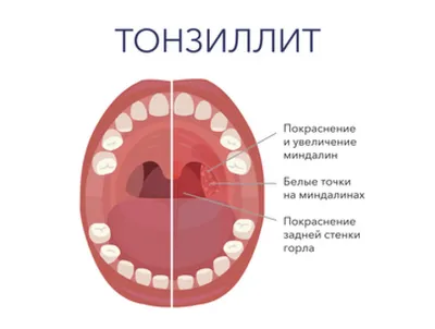 Тонзиллит | Симптомы | Диагностика | Лечение - Lik.ua