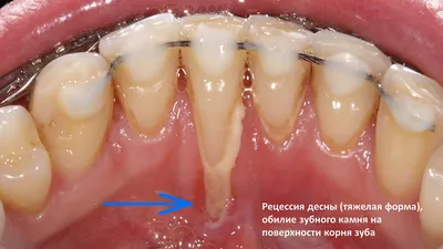 Про заболевания десен часть 1: рецессии десны. Оголение корней зуба.