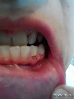 Белый налет на десне после удаления зуба фото фотографии