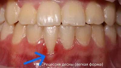 Про заболевания десен часть 1: рецессии десны. Оголение корней зуба.