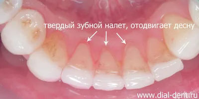 Почему появляются белые пятна во рту? 6 возможных причин | Стоматология  ROOTT | Дзен