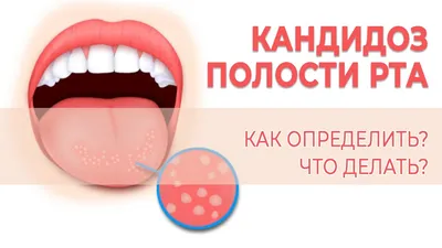 Белые пятна на зубах у ребенка: почему появляются и как убрать