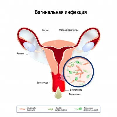 Вульвит - причины появления, симптомы заболевания, диагностика и способы  лечения