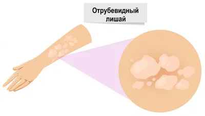 Фимоз и синехии у мальчиков