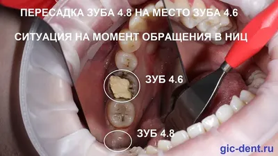 Альвеолит после удаления зуба: фото, лечение, сухая лунка | Dental Art
