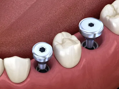 Белый налет после удаления зуба - почему, сколько держится, что делать