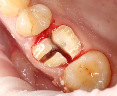 Как заживает лунка после удаления зуба? | Стоматология ROOTT | Дзен