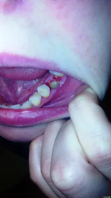 Альвеолит - воспаление десны после удаления зуба